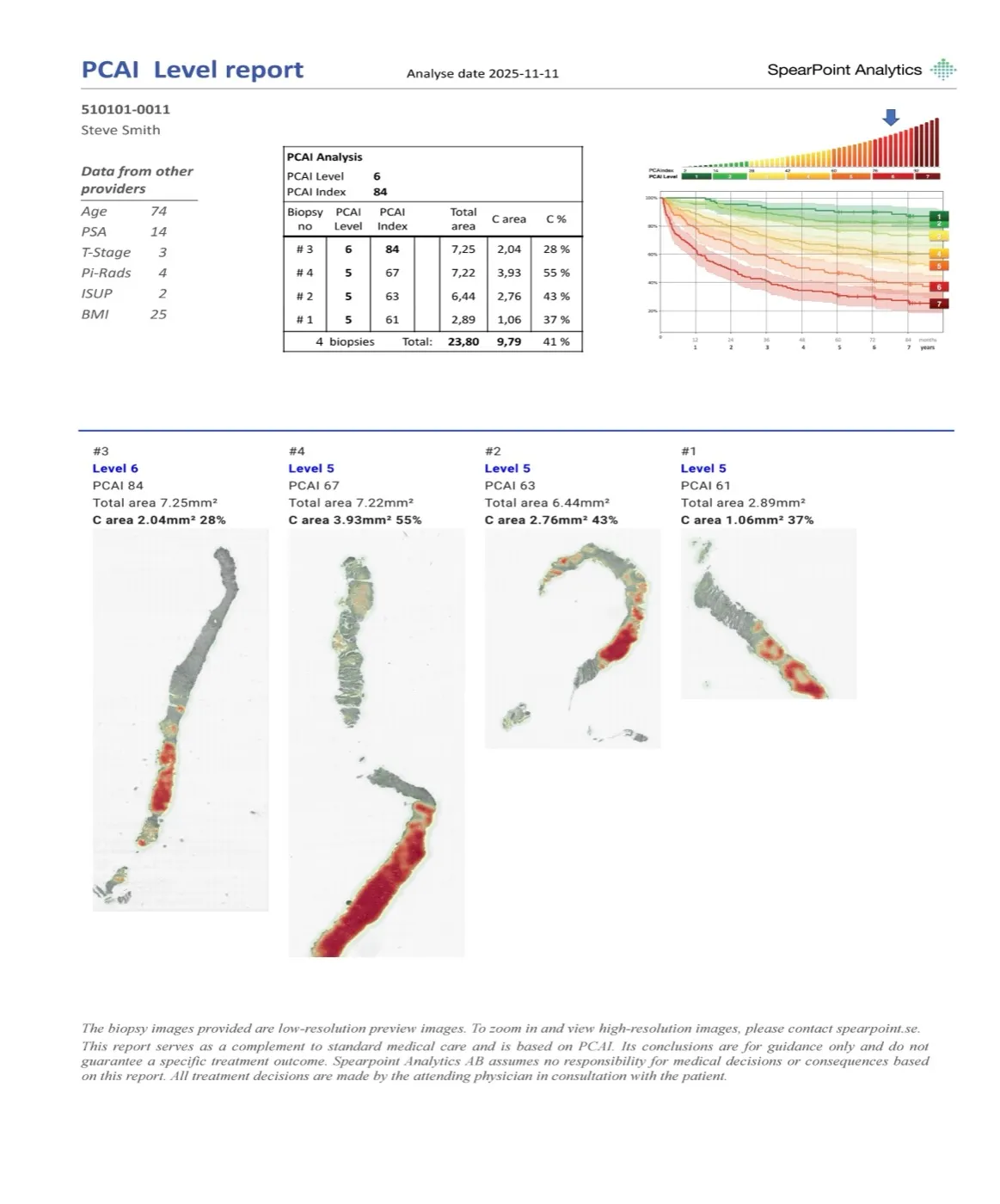 Example of a PCAI report with index, risk level and colour-marked cancer areas in four biopsies